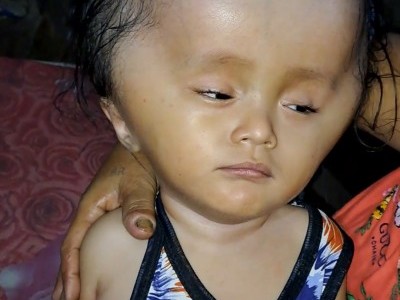 A Child that have HYDROCEPHALUS?